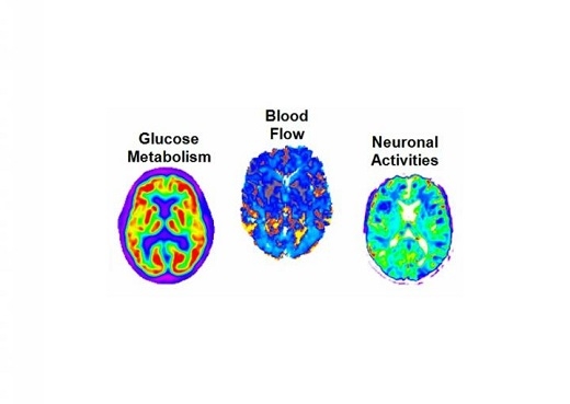 This study used multiple imaging techniques to measure amyloid concentration, glucose metabolism, cerebral blood flow, functional activity and brain atrophy in 78 regions of the brain, covering all grey matter.