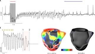 CAPTION A: Optogenetic defibrillation (blue bar) stops arrhythmia in mouse heart. B: Simulation of optogenetic defibrillation (red bar) in a model of a human heart. CREDIT © Image: Tobias Brügmann (University Bonn)/Patrick M. Boyle (Johns Hopkins University)