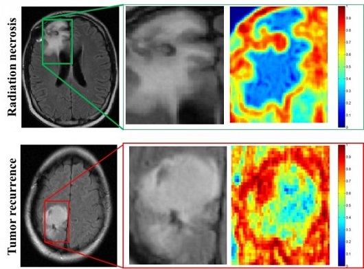MRI scans of patients with radiation necrosis (above) and cancer recurrence (below) are shown in the left column. Close-ups in the center column show the regions are indistinguishable on routine scans. Radiomic descriptors unearth subtle differences showing radiation necrosis, in the upper right panel, has less heterogeneity, shown in blue, compared to cancer recurrence, in the lower right, which has a much higher degree of heterogeneity, shown in red. Credit: Pallavi Tiwari