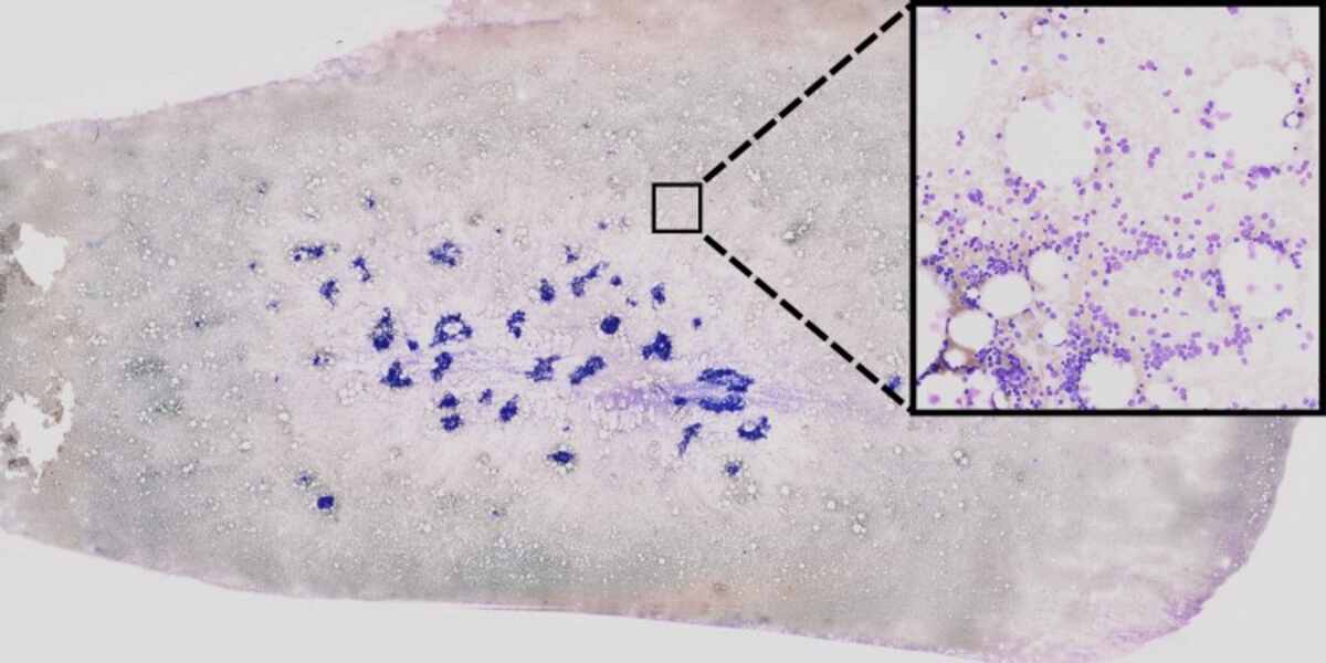 The use of AI-based processing of bone-marrow smears is being explored to assist in the diagnosis of leukemia. This involves the extraction of single-cell images from high-resolution data through unsupervised learning methods. The cell images are then analyzed using neural networks to identify any visual anomalies that may have a genetic origin. The neural network highlights important areas for decision-making using "explainable AI" strategies, which are indicated by colored highlights. The credit for this image goes to AG Risse. The use of AI-based processing of bone-marrow smears is being explored to assist in the diagnosis of leukemia. This involves the extraction of single-cell images from high-resolution data through unsupervised learning methods. The cell images are then analyzed using neural networks to identify any visual anomalies that may have a genetic origin. The neural network highlights important areas for decision-making using "explainable AI" strategies, which are indicated by colored highlights. The credit for this image goes to AG Risse.
