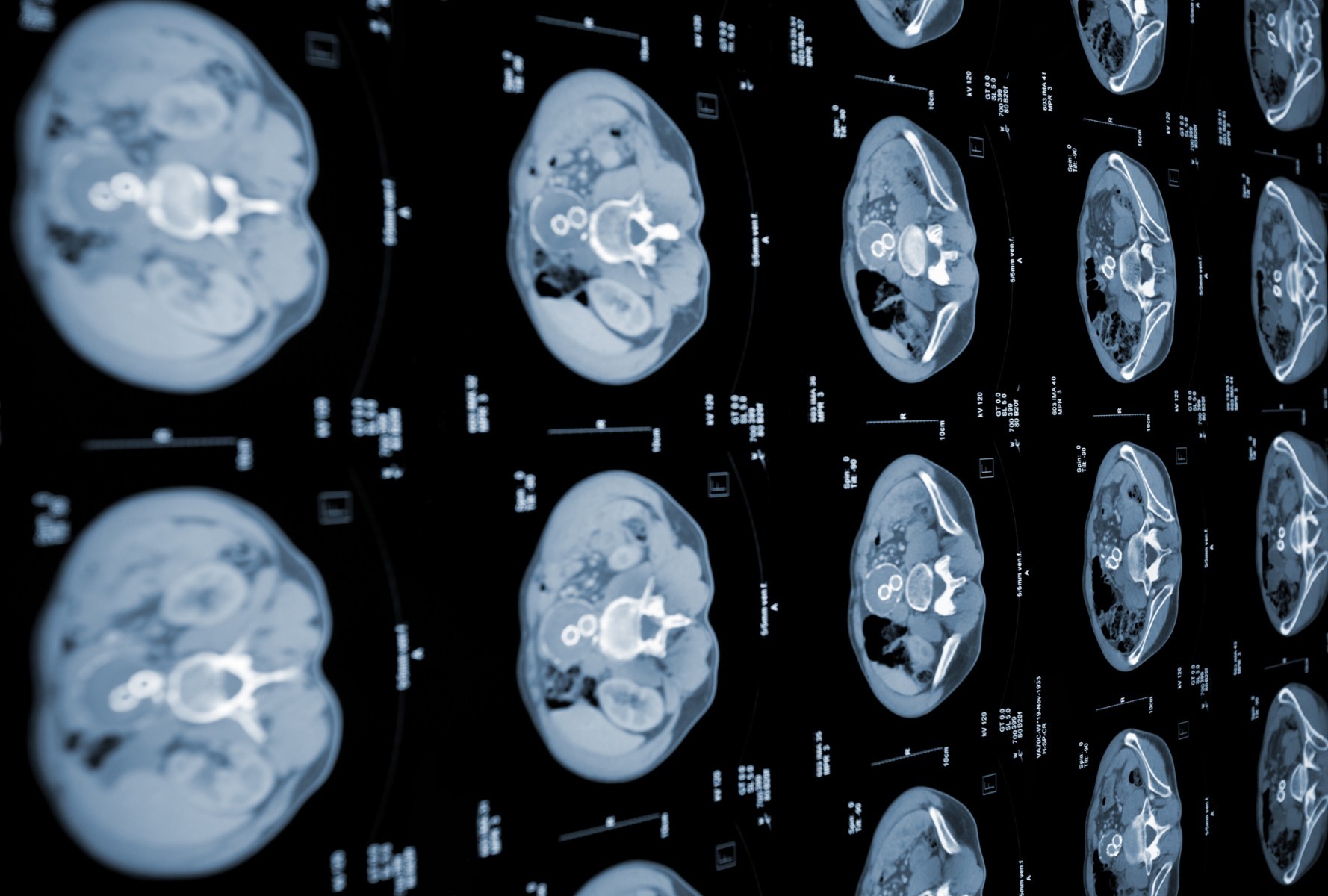 An AI tool developed by Cedars-Sinai investigators could eventually be used to detect early pancreatic cancer in people undergoing CT scans for abdominal pain or other issues. Photo by Getty Images. An AI tool developed by Cedars-Sinai investigators could eventually be used to detect early pancreatic cancer in people undergoing CT scans for abdominal pain or other issues. Photo by Getty Images.