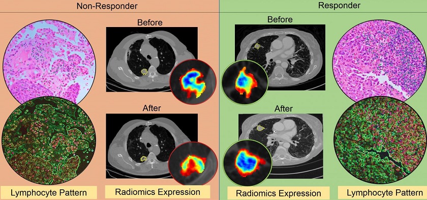 An illustration of the differences in CT radiomic patterns before and after initiation of checkpoint inhibitor therapy. Also, density of tumor infiltrating lymphocytes, on diagnostic biopsies, was found to be higher in responders as compared to non-responders.