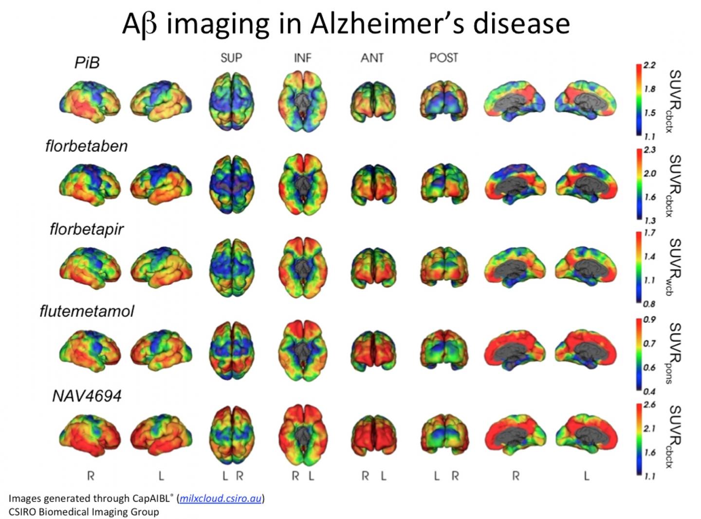 These images were generated through the CapAIBL CSIRO Biomedical Imaging Group. These images were generated through the CapAIBL CSIRO Biomedical Imaging Group.
