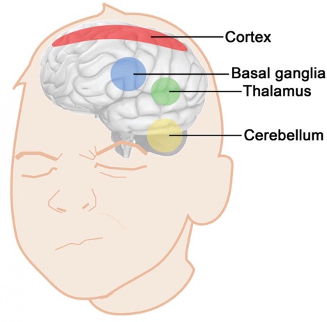 CAPTION Key brain areas forming the "system" underlying tic production. CREDIT Figure realized by Beste Özcan.