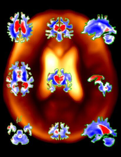 Researchers collated the brain MRIs of 4,681 cognitively normal participants, some of whom went on to develop cognitive decline or Alzheimer’s disease later in life. (Illustration/Courtesy of the USC Leonard Davis School of Gerontology)