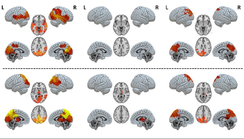 Response differences in brain circuits when broadcasting (top row) or receiving signals (bottom row). Left: healthy controls; Middle: unresponsive wakefulness; Right: minimally conscious Response differences in brain circuits when broadcasting (top row) or receiving signals (bottom row). Left: healthy controls; Middle: unresponsive wakefulness; Right: minimally conscious