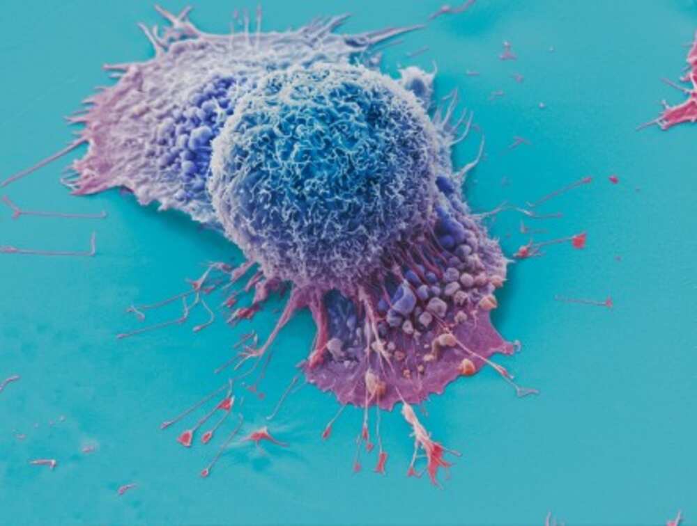 This is a false-color scanning electron micrograph that shows lung cancer cells grown in culture. The image is courtesy of Anne Weston. A new AI tool named PERCEPTION is helping predict patients' response to various therapies by utilizing data at the level of individual cells. This is a false-color scanning electron micrograph that shows lung cancer cells grown in culture. The image is courtesy of Anne Weston. A new AI tool named PERCEPTION is helping predict patients' response to various therapies by utilizing data at the level of individual cells.