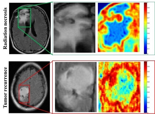 MRI scans of patients with radiation necrosis (above) and cancer recurrence (below) are shown in the left column. Close-ups in the center column show the regions are indistinguishable on routine scans. Radiomic descriptors unearth subtle differences showing radiation necrosis, in the upper right panel, has less heterogeneity, shown in blue, compared to cancer recurrence, in the lower right, which has a much higher degree of heterogeneity, shown in red. Credit: Pallavi Tiwari MRI scans of patients with radiation necrosis (above) and cancer recurrence (below) are shown in the left column. Close-ups in the center column show the regions are indistinguishable on routine scans. Radiomic descriptors unearth subtle differences showing radiation necrosis, in the upper right panel, has less heterogeneity, shown in blue, compared to cancer recurrence, in the lower right, which has a much higher degree of heterogeneity, shown in red. Credit: Pallavi Tiwari